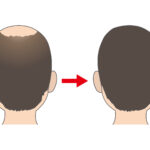 増毛の人工毛髪